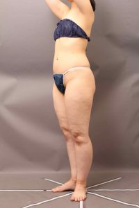 太腿のvaser脂肪吸引